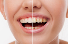 Restoratif Diş Tedavisi Nedir? Çürük ve Kırık Dişlere Estetik Çözümler